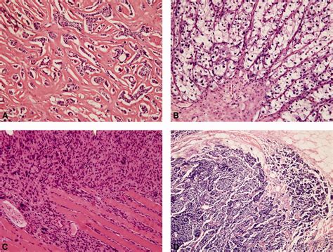 Soft Tissue Metastasis 